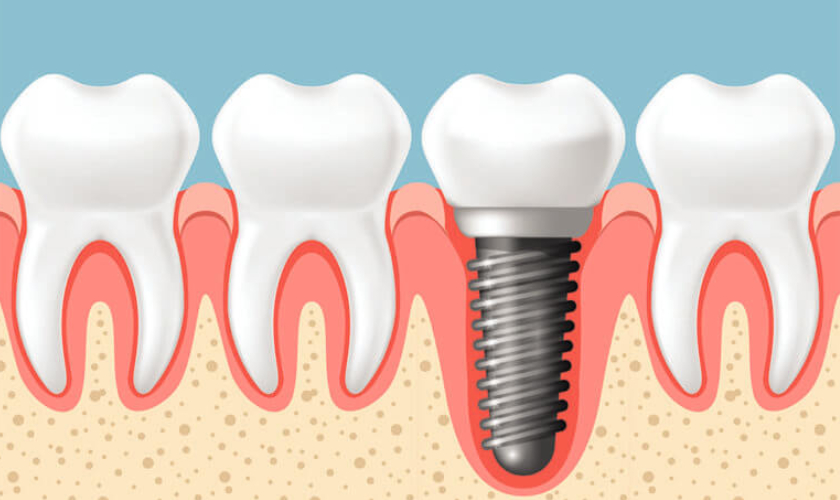 Featured image for “Dental Implants: Types, Treatments & Recovery”