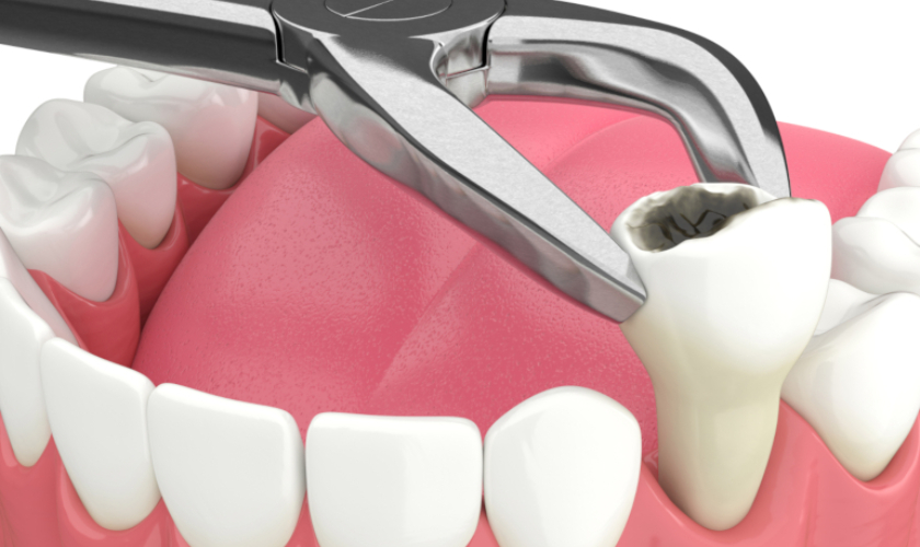 Featured image for “Tooth Extractions: What You Need To Know”